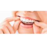 Was ich vor der Invisalign-Behandlung gerne gewusst hätte