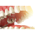 🦷 Wenn ich einen Hohlraum hätte, würde ich genau hier umkehren