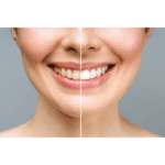 🦷 Deine Zähne sind nicht gelb-sie sind gefärbt (und meine Must-Haves, sie zu reparieren)