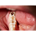 🦷 Können Sie tatsächlich einen Hohlraum umkehren?