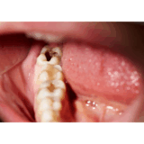 🦷 Können Sie tatsächlich einen Hohlraum umkehren?